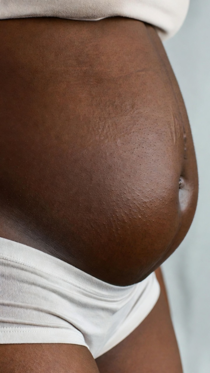 Stretch marks on belly skin